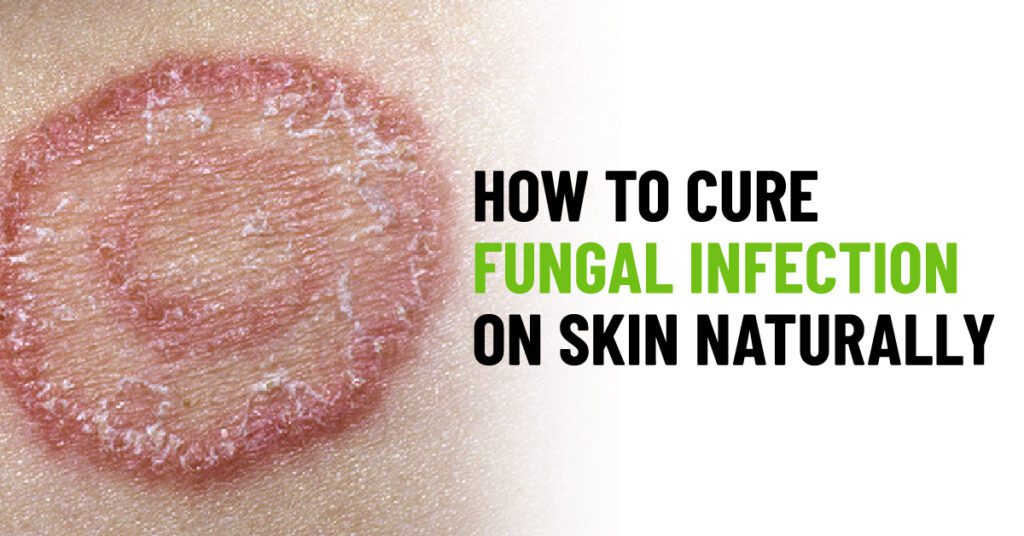 How to Cure Fungal Infection on Skin Naturally